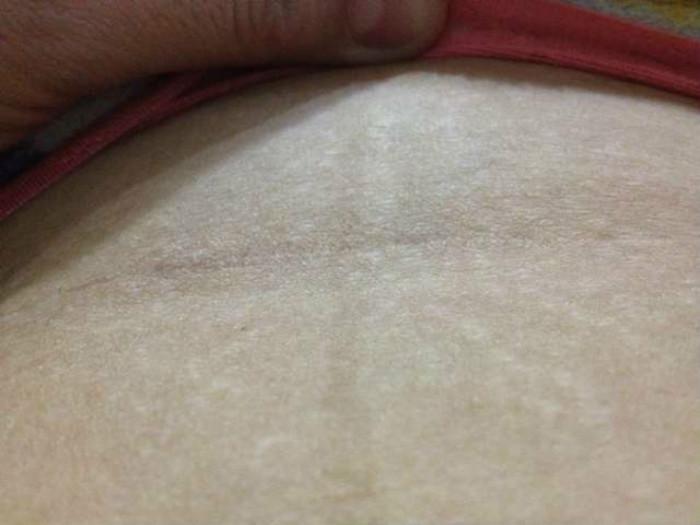 剖腹产疤痕越来越大有危害吗,剖腹产留下的疤痕有什么危害