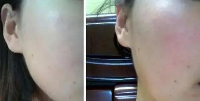 冻干祛痘面膜推荐,适合祛红痘印的面膜推荐