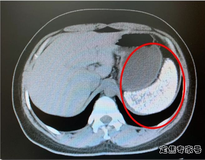 女孩脾脏被异物塞得密密麻麻...医生切开后，吓出一身鸡皮疙瘩！