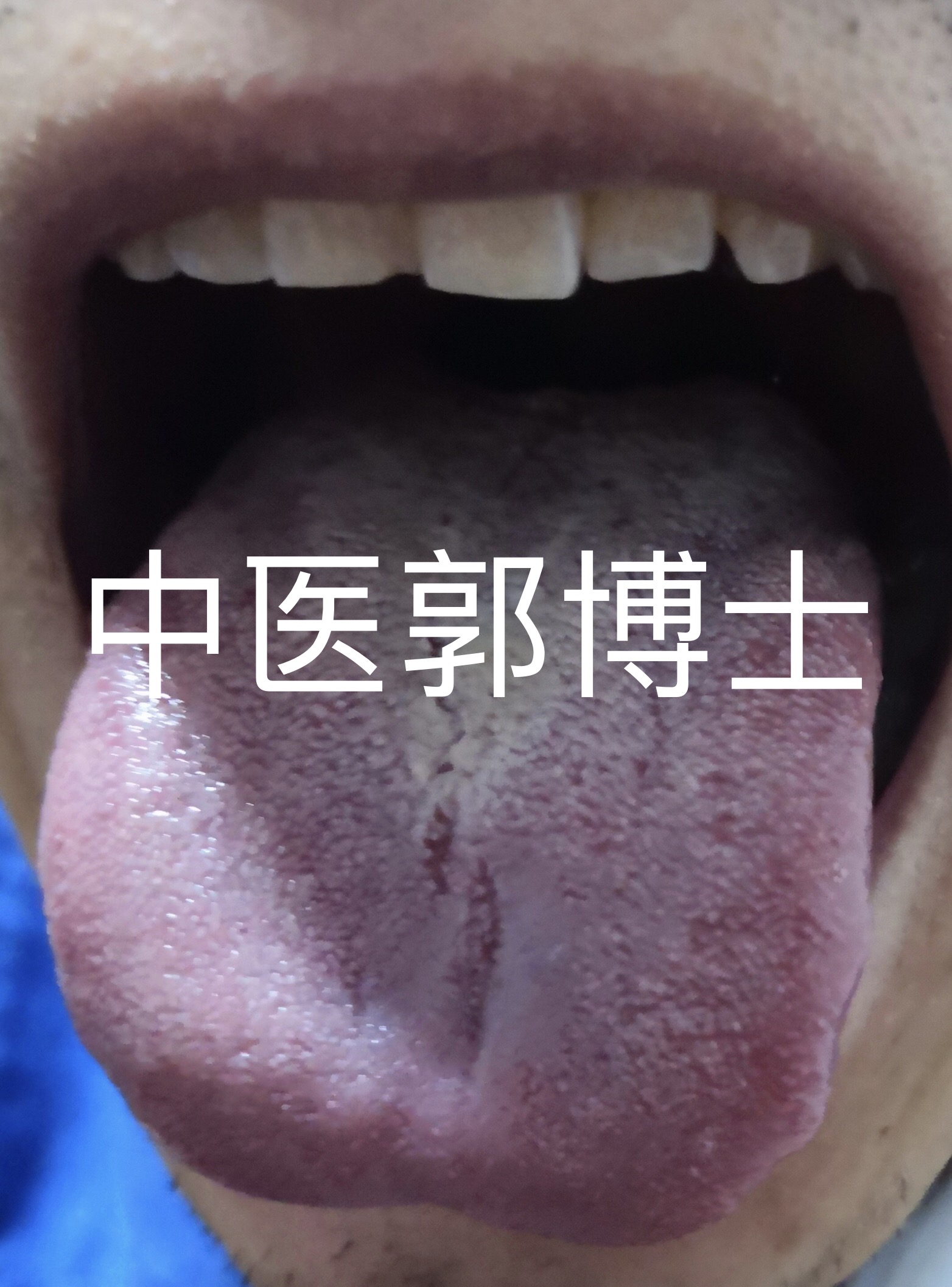 感冒后流虚汗咳嗽吃什么中药好,感冒口干浑身酸疼干咳经方