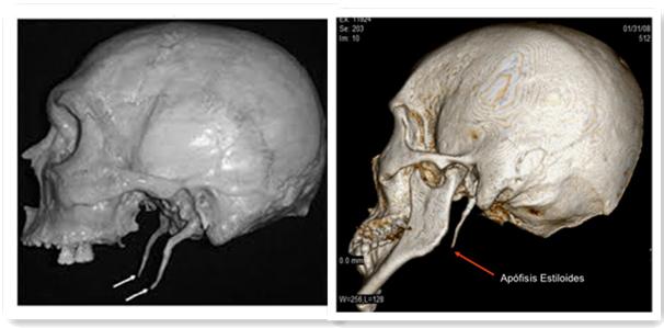 翼钩综合症是什么病能治愈吗,颌面疼痛是怎么回事