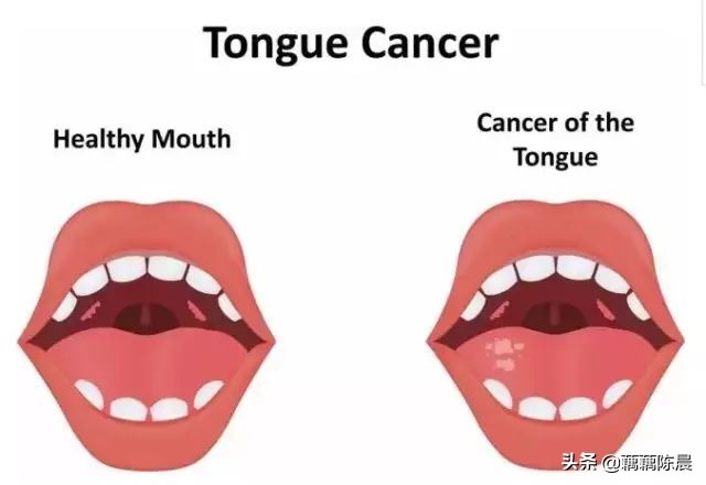 癌的早期信号!医生呼吁:早知道能救命!