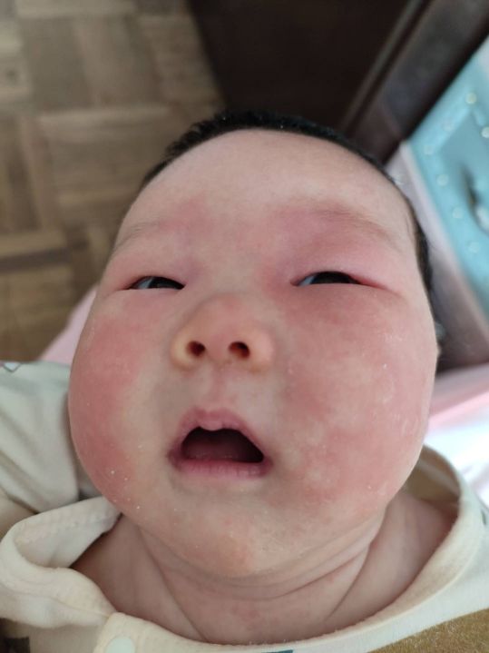 根治湿疹特效药,宝宝湿疹大作战图文