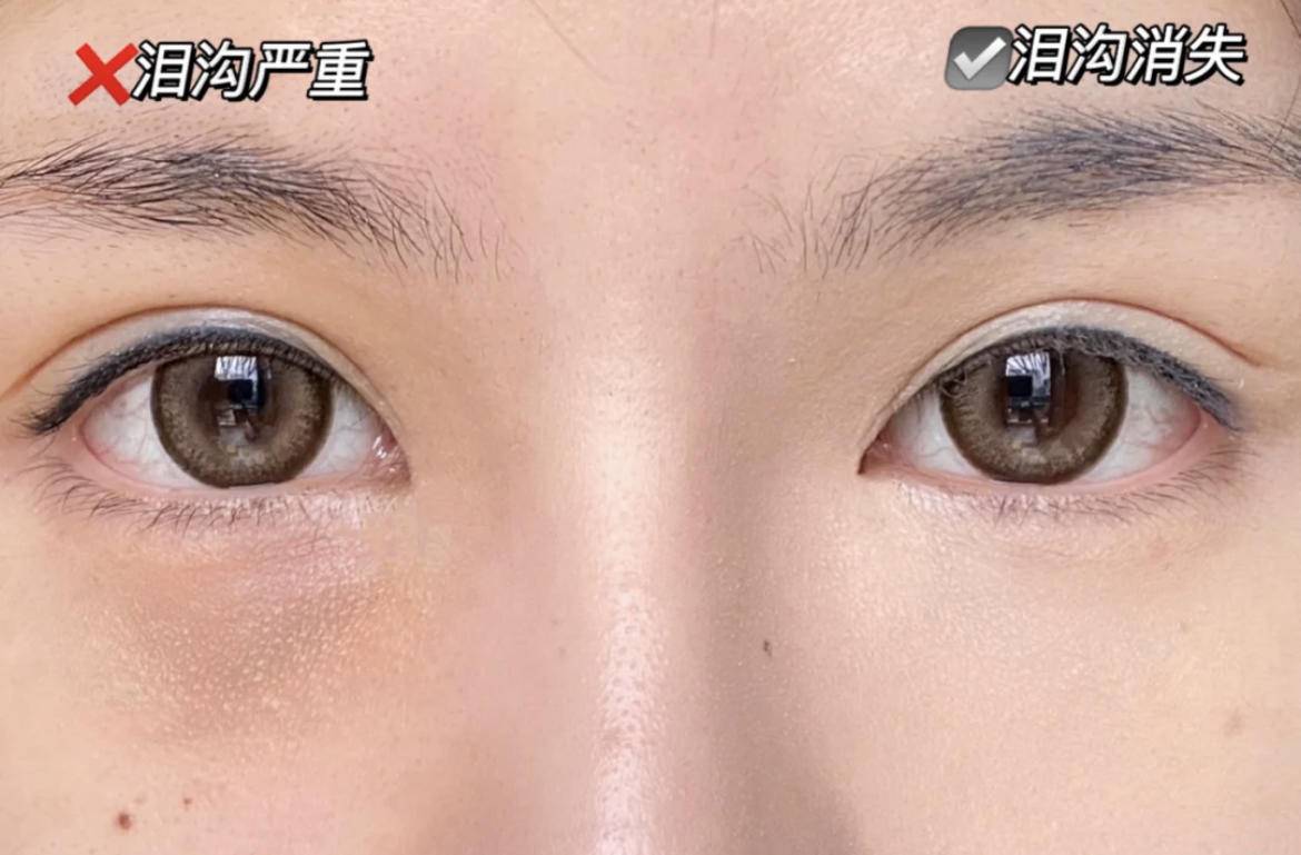 熬夜引起的泪沟黑眼圈能消失么,万年黑眼圈眼袋泪沟怎么遮瑕
