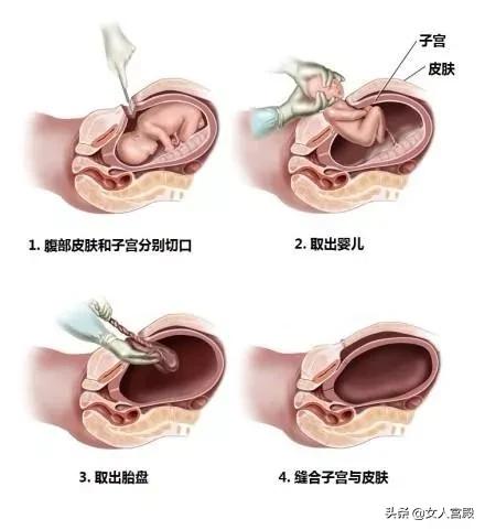 盆底肌松了该吃什么药,盆底肌松能练登山步吗