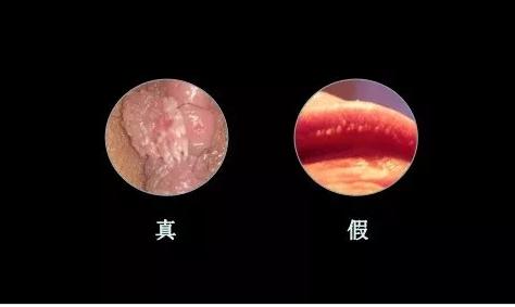 假性湿疣与尖锐性湿疣鉴别方法,尖锐假性湿疣怎么治