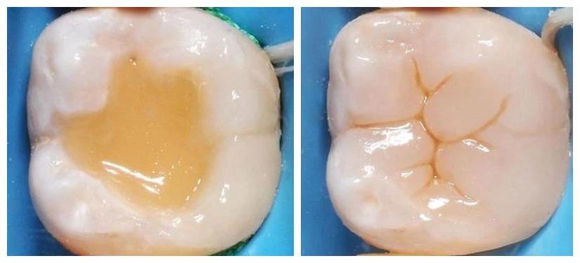 为什么补了牙齿反而牙齿痛,牙齿不痛牙龈疼痛为什么