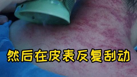 祛风散寒刮痧方法,天气冷身体痒中医如何处理