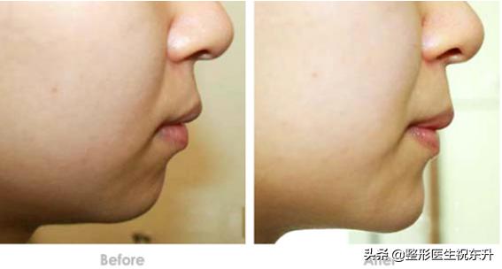 丰下巴的假体需要取出来吗？