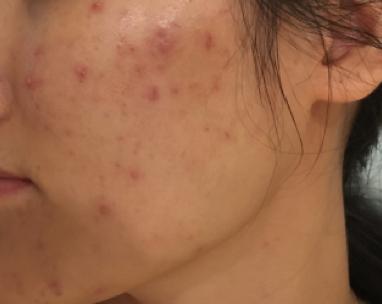 青春期月经逐渐规律的过程中长痘,青春期的痘痘来月经后会消失吗