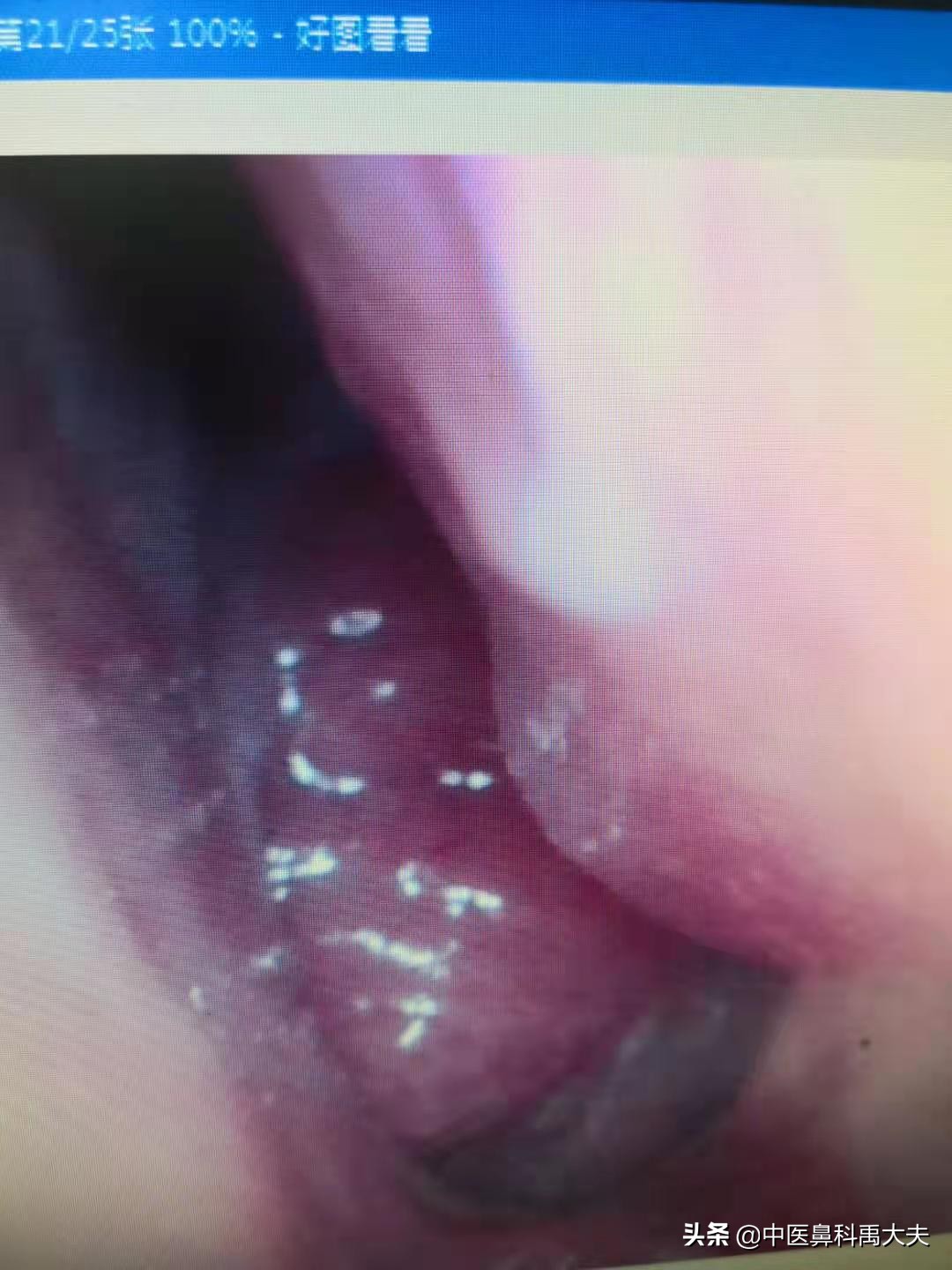 什么是腺样体肥大面容图片,腺样体肥大是什么样子的