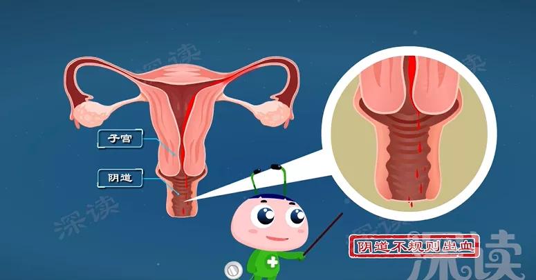 有盆腔炎是不是白带不正常,盆腔炎为什么会白带异常