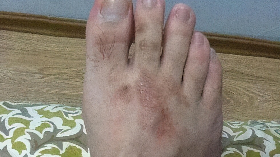 得了脚气到底会不会传染到其他部位？