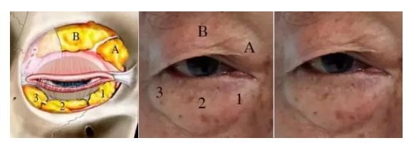 龚忠华整形,龚忠华双眼皮手术后多久恢复