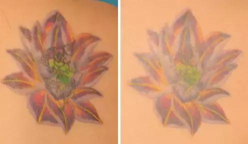 纹身的激光治疗,激光能祛纹身吗