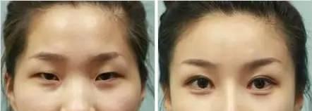 看过邓伦的丹凤眼和刘昊然的三角眼，还要都变成双眼皮吗