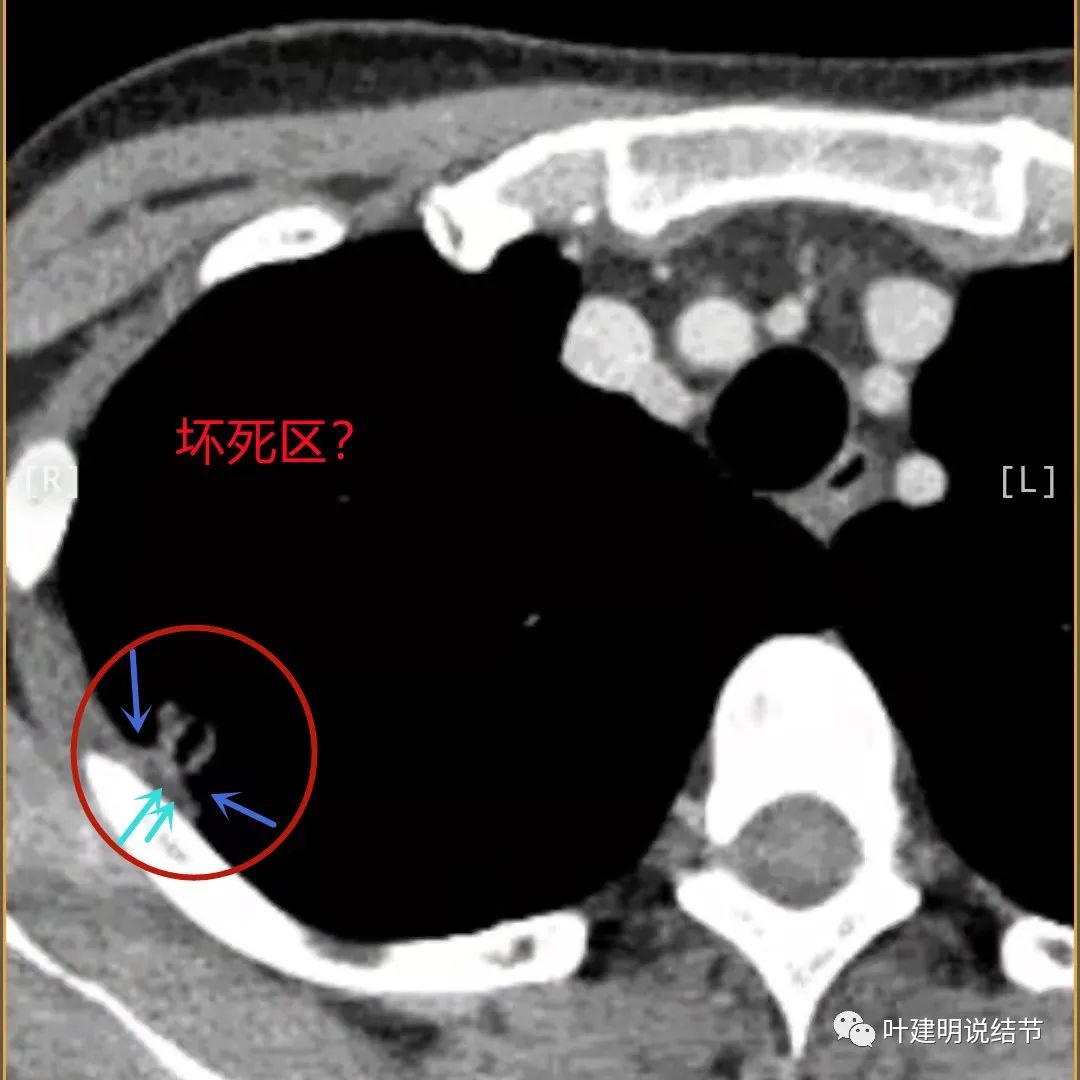 临床诊断孤立性肺结节,空洞型结节一般是什么性质
