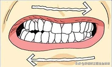 矫正牙齿后不戴牙齿保持器会怎样,牙齿矫正后不戴矫正器会变回去吗
