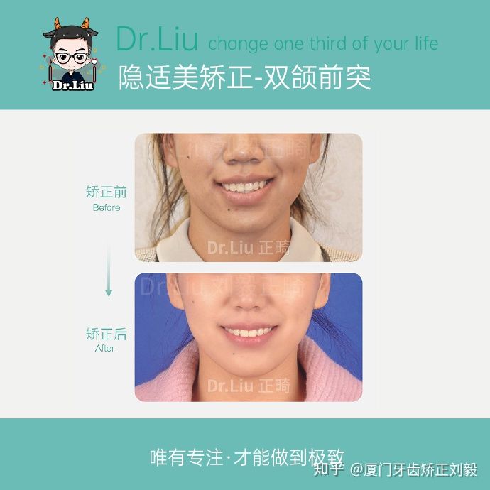 下嘴唇厚且外翻牙齿矫正,深覆合牙齿矫正嘴凸