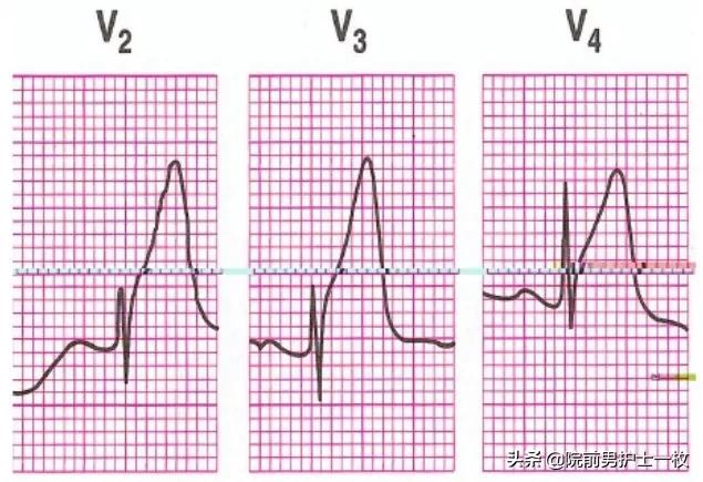 急性心梗的紧急处理视频,一旦发现急性心梗如何救