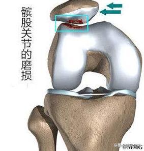 膝盖后面有个鼓鼓的包是不是病,膝盖后面有个包怎么回事