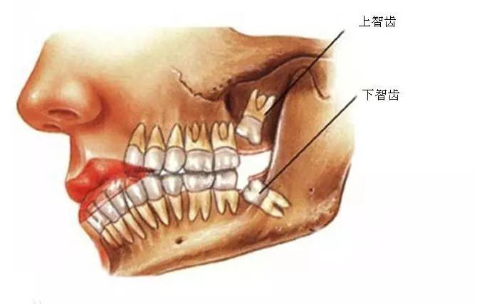 长智齿为什么老一辈不建议拔智齿,拔智齿后的心得分享