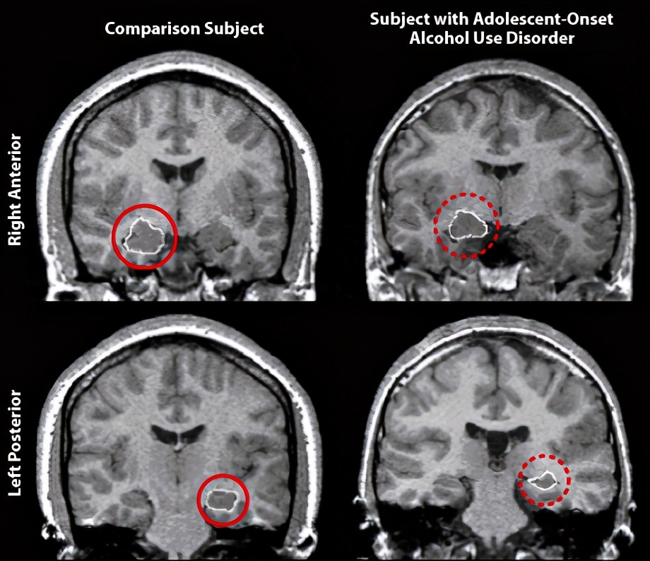 为什么少儿不能喝酒？酒精与学习成绩