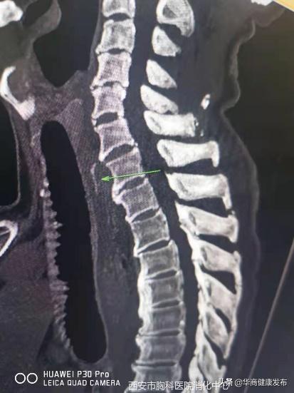 骨鲠,消化内镜可以做什么治疗