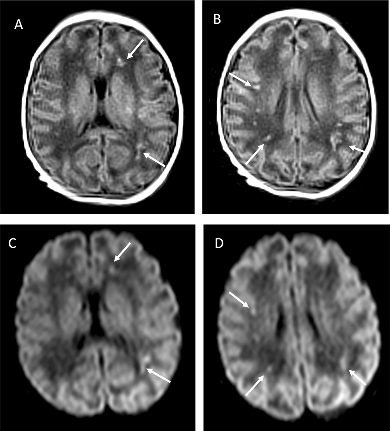 新冠母婴传播,新冠婴儿容易感染吗