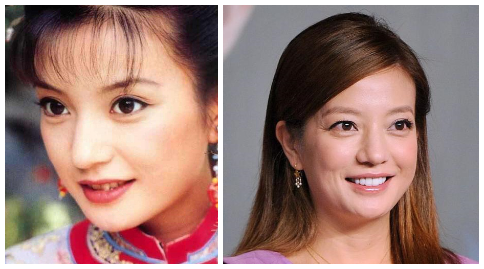 切眼袋会加速衰老的案例,割双眼皮衰老更快