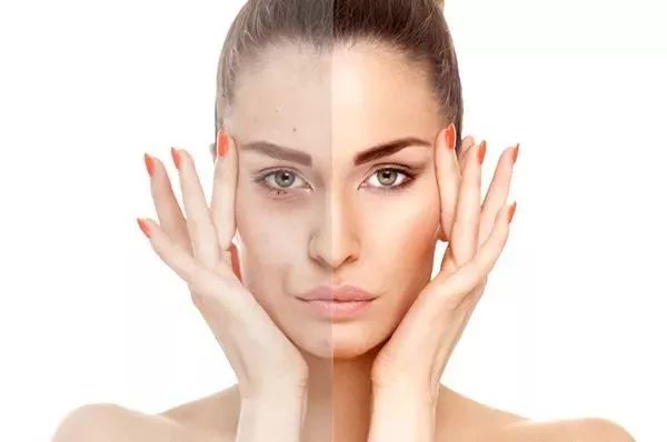 目前治疗痘痘粉刺最好的方法,治疗黑头粉刺最便宜有效的方法