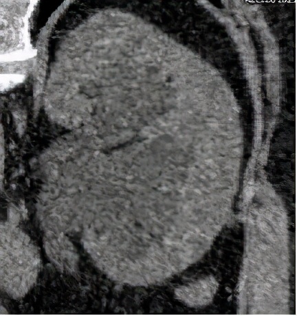 尿路梗阻导致肾积水不及时治疗,双肾积水是尿路梗阻吗