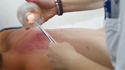 肩周炎颈椎病怎样拔火罐,拔火罐可以治疗颈椎病