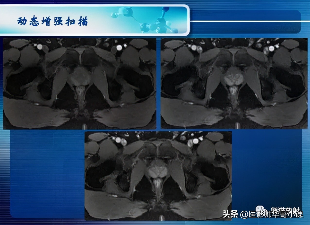 前列腺磁共振影像解剖,前列腺mri正常诊断报告模板