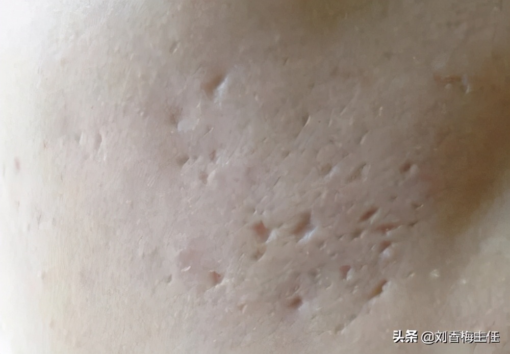 痘印痘坑对颜值的影响,严重的痘坑护肤可以修复吗