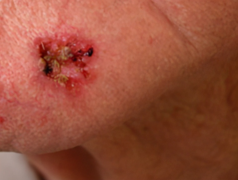 点痣点出恶性肿瘤,点痣点出黑色素瘤