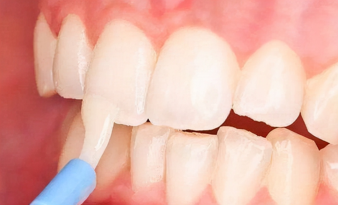 窝沟封闭和涂氟防龋哪个好,儿童防牙氟的最佳方法