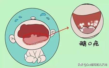 什么事鹅口疮？得了鹅口疮应该怎么办？