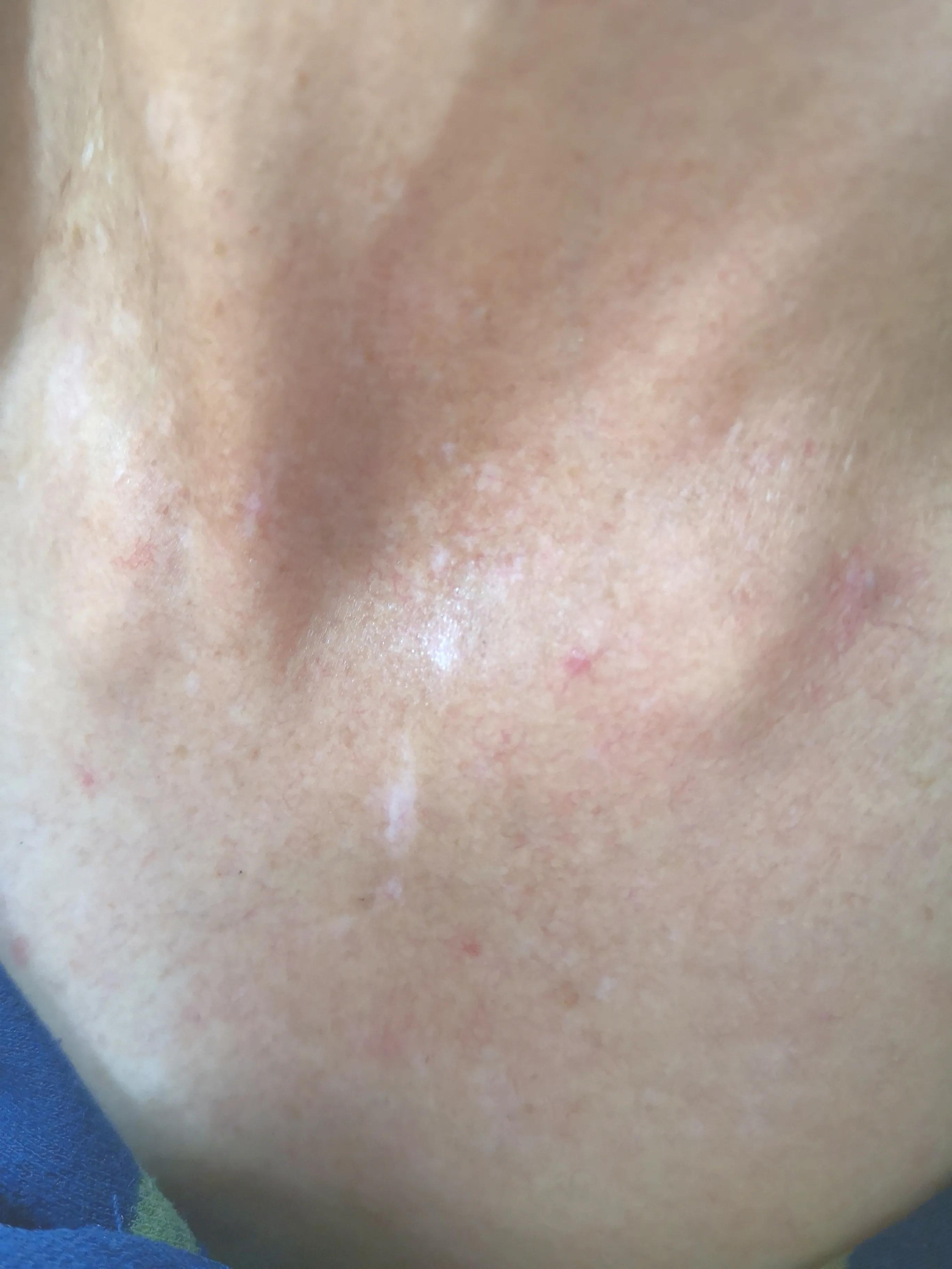 突然间长白癜风怎么回事,身上出现小白点医生说是白癜风