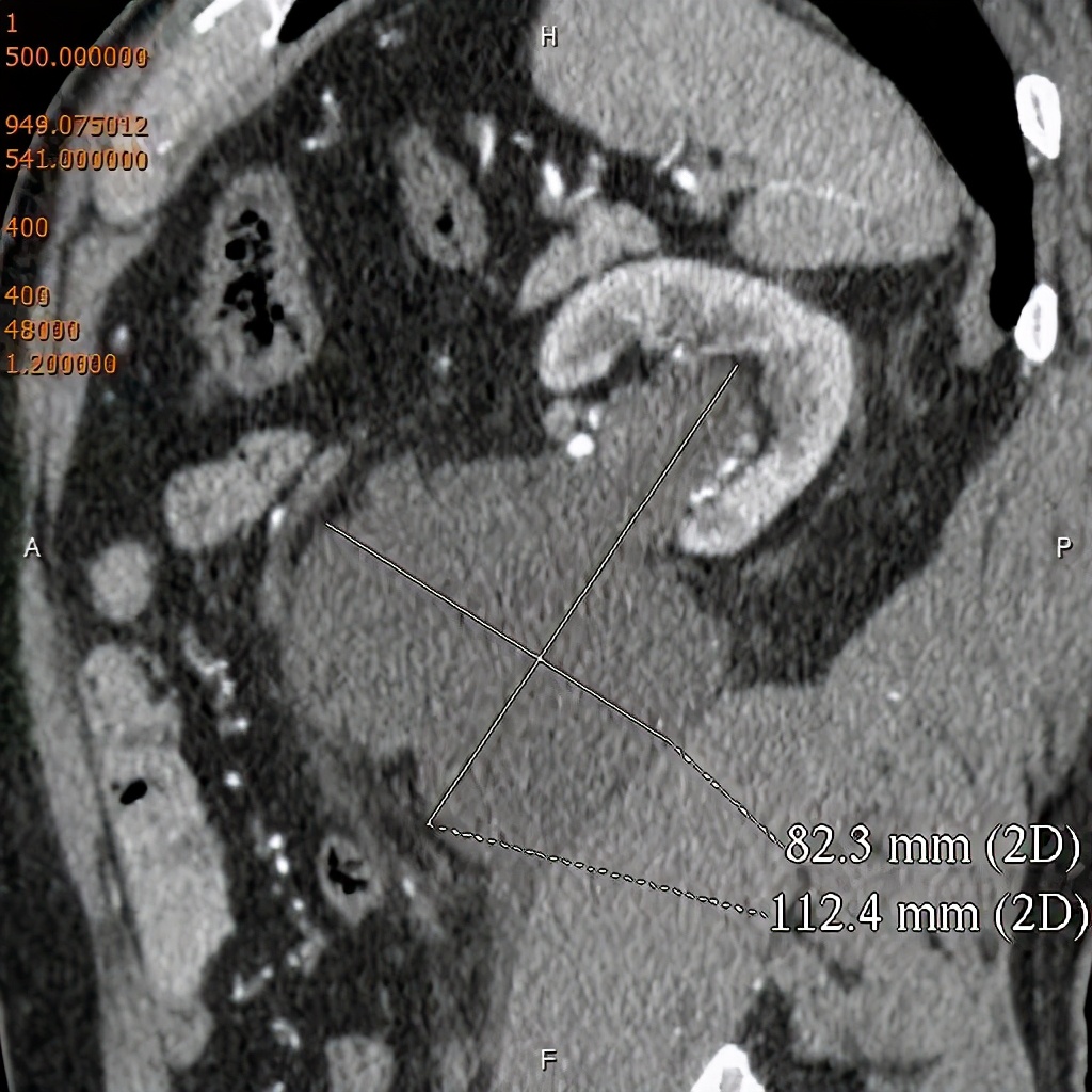 尿路造影输尿管间断显影,静脉尿路造影和排泄性尿路造影