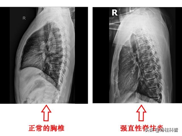 强直治愈副作用,强直需要哪些康复训练