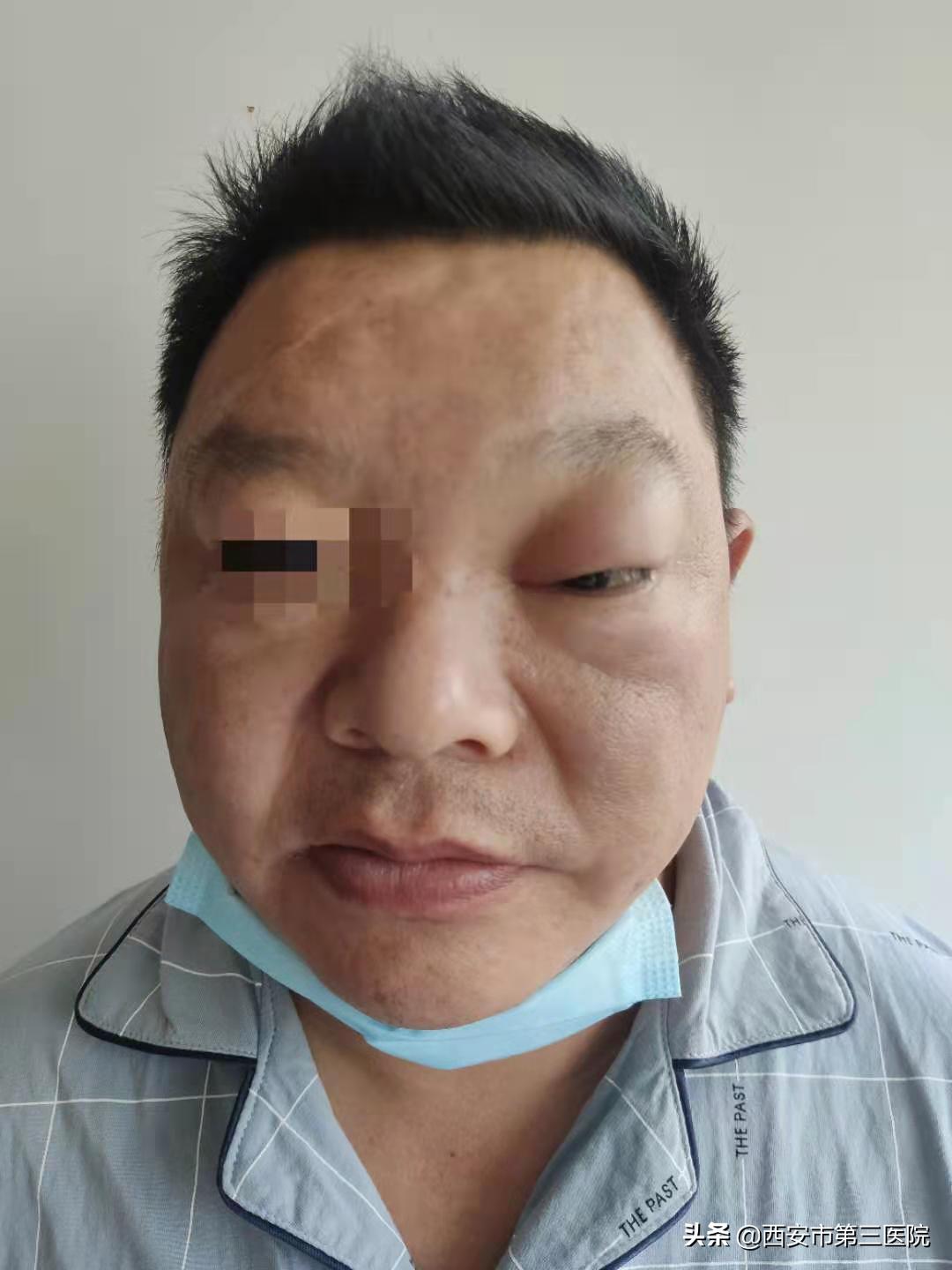 治愈鼻窦炎有好的方法么,鼻窦炎反复发作疼痛难以忍受