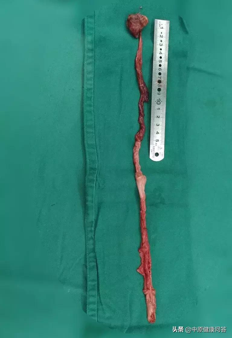 2个月宝宝泌尿系统畸形,小孩肚子肠子畸形会有什么特点