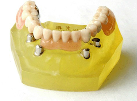 现在最便宜的假牙多少钱一颗,目前国内最好的假牙是多少钱