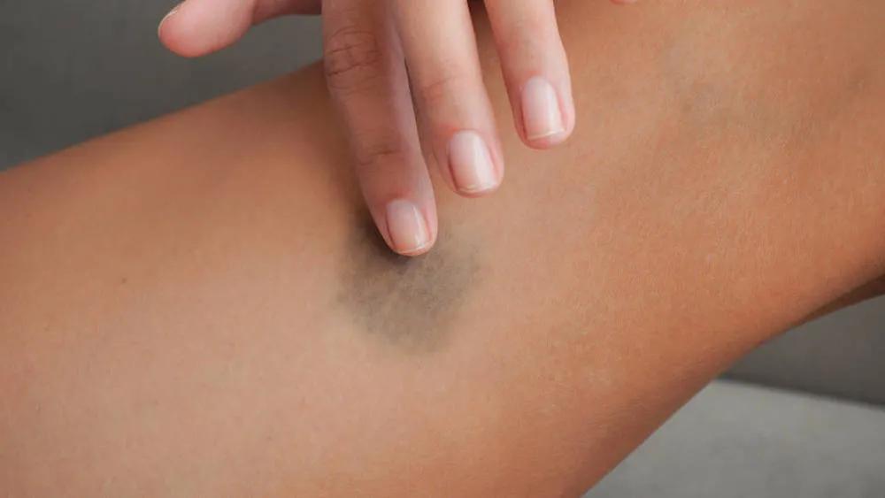 大面积乌青怎么快速消除,乌青块摸上去有个疙瘩正常吗