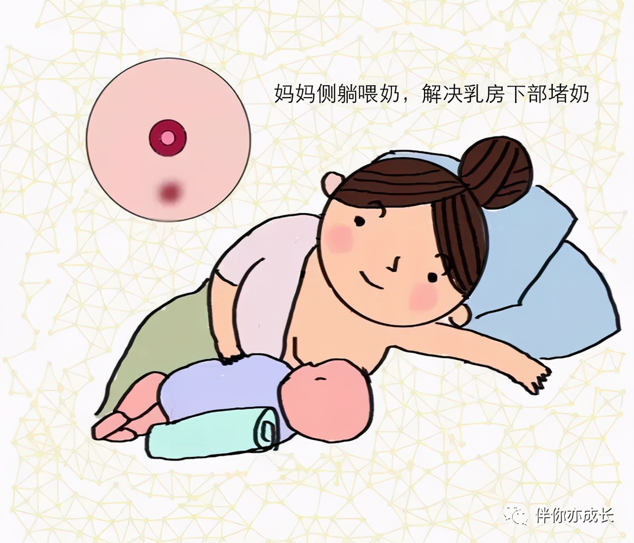 堵奶如何处理最有效,乳腺管不通奶堵怎么处理