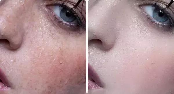 痘印很顽固怎么祛痘印,痘印祛痘药膏