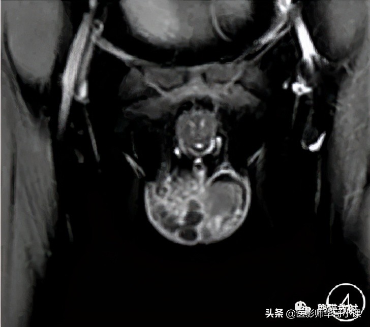 [精品课件]畸胎瘤及精原细胞瘤（*丸睾**肿瘤及肿瘤样变CT及MR表现）