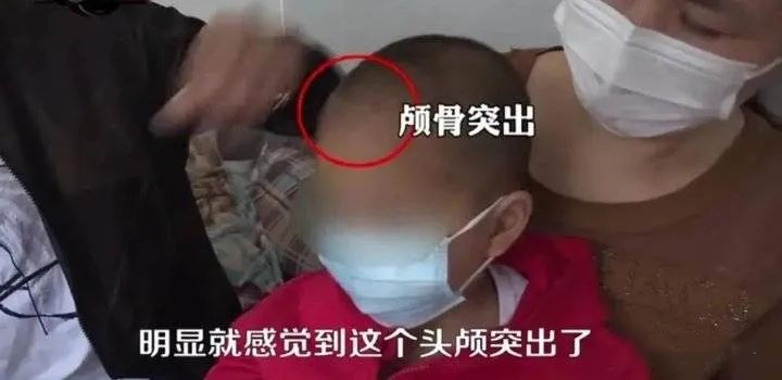 湖南郴州大头娃娃奶粉事件,郴州大头娃娃事件原因