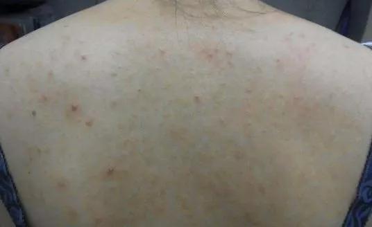 羊奶皂能去鸡皮肤吗,驴奶皂与羊奶皂哪个好